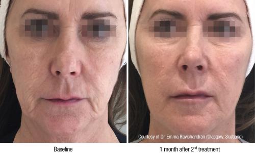 Majel B.V. | Behandeling van de maand december: PROFHILO!